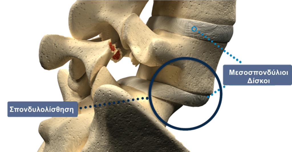 Σπονδυλολίσθηση - Αγγελόπουλος Αθανάσιος - Ορθοπεδικός χειρούργος
