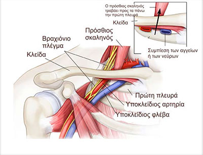 Σύνδρομο θωρακικής εξόδου - Αγγελόπουλος Αθανάσιος - Ορθοπεδικός χειρούργος